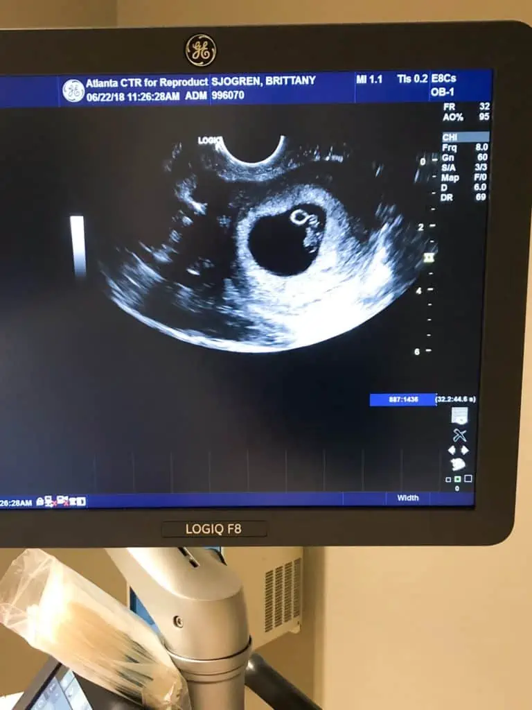 baby ultrasound following IVF infertility treatment